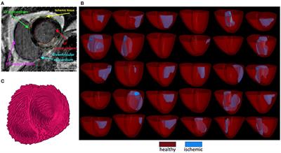 Combined In-silico and Machine Learning Approaches Toward Predicting Arrhythmic Risk in Post-infarction Patients